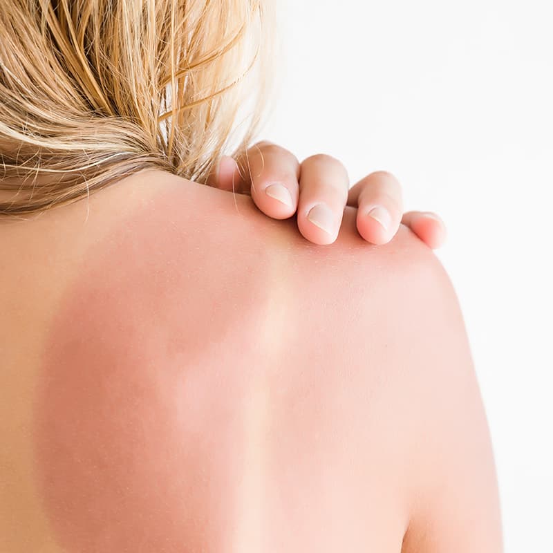 Sunburn relief - Dr. Axe